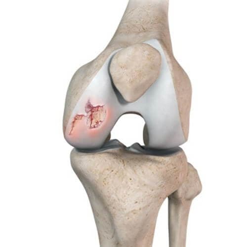 Weakness that makes your knee feel unstable