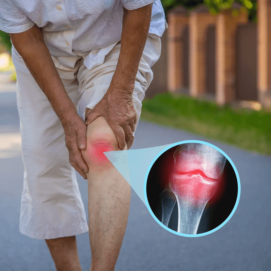 Cartilage erosion illustration