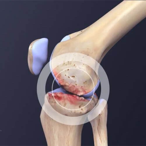 Joint Inflammation