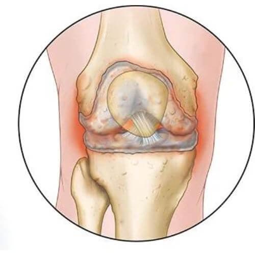 Osteoarthritis