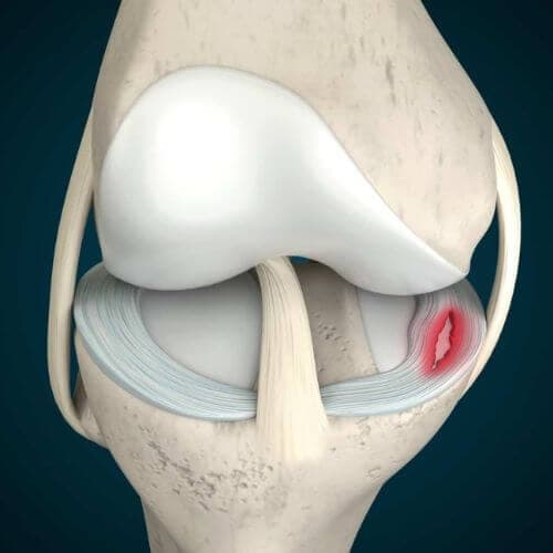 Meniscus Tear