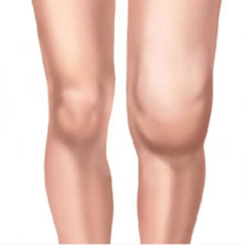 Swelling and stiffness